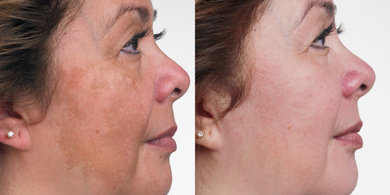 Malasma Treatment at Clínica Privé