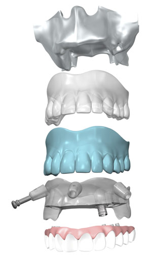 NobelGuide Tochnology at PERFECT SMILE Dental Clinic