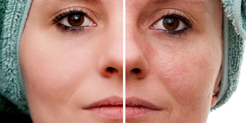 ACNE Scar Treatments at Clínica Privé