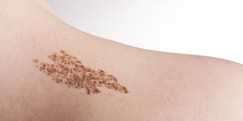 Laser Birthmark Removal at Clínica Privé