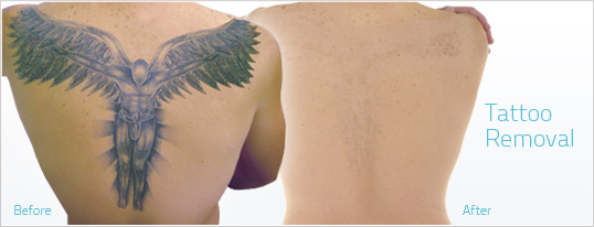 TATTOO Removal at Privé MEDSPA