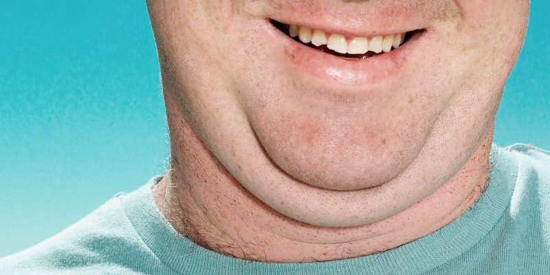 Double Chin Treatments at Clínica Privé