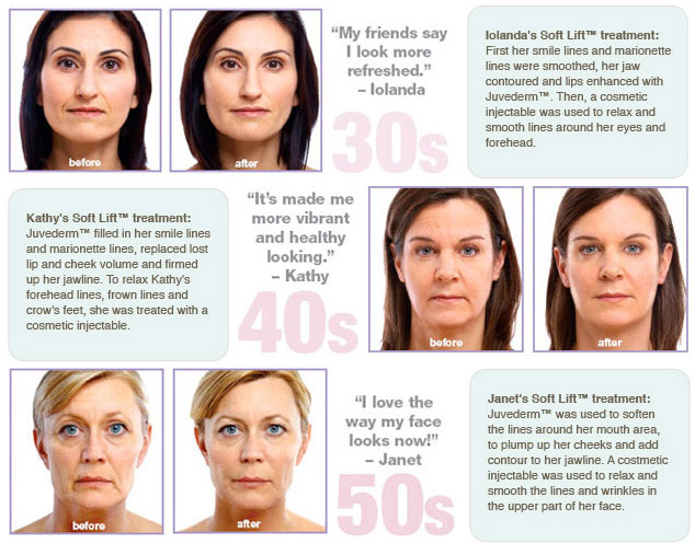 Non Surgical Face Lift | PERFECT FACE | Facial LASER Aesthetics Clinic ...